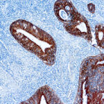 Immunohistochemical staining of pan-Cytokeratins  of human FFPE tissue followed by incubation with HRP labeled secondary and development with DAB substrate.