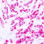 Immunohistochemical staining of EpCAM of human FFPE tissue followed by incubation with HRP labeled secondary and development with DAB substrate.