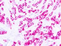 Immunohistochemical staining of EpCAM of human FFPE tissue followed by incubation with HRP labeled secondary and development with DAB substrate.