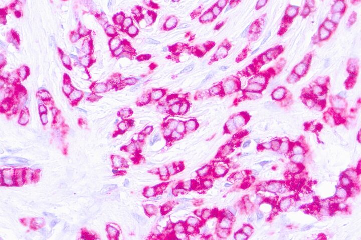 Immunohistochemical staining of EpCAM of human FFPE tissue followed by incubation with HRP labeled secondary and development with DAB substrate.