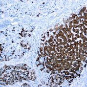 Immunohistochemical staining of Hepatocyte Specific Antigen  of human FFPE tissue followed by incubation with HRP labeled secondary and development with DAB substrate.