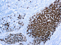 Immunohistochemical staining of Hepatocyte Specific Antigen  of human FFPE tissue followed by incubation with HRP labeled secondary and development with DAB substrate.