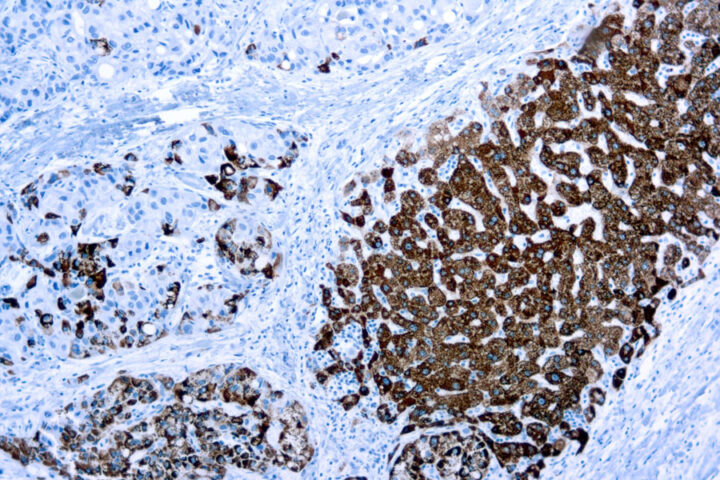 Immunohistochemical staining of Hepatocyte Specific Antigen  of human FFPE tissue followed by incubation with HRP labeled secondary and development with DAB substrate.