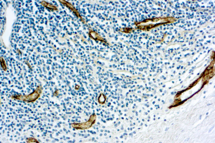 Immunohistochemical staining of Factor VIII Related /Von Willebrand Factor  of human FFPE tissue followed by incubation with HRP labeled secondary and development with DAB substrate.