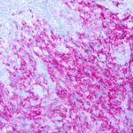 Immunohistochemical staining of Fixative Resistant Melanocyte Antigen  of human FFPE tissue followed by incubation with HRP labeled secondary and development with DAB substrate.