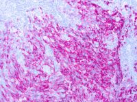 Immunohistochemical staining of Fixative Resistant Melanocyte Antigen  of human FFPE tissue followed by incubation with HRP labeled secondary and development with DAB substrate.