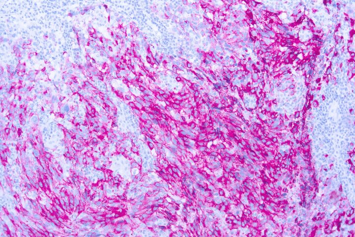 Immunohistochemical staining of Fixative Resistant Melanocyte Antigen  of human FFPE tissue followed by incubation with HRP labeled secondary and development with DAB substrate.