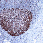 Immunohistochemical staining of Proliferating Cell Nuclear Antigen  of human FFPE tissue followed by incubation with HRP labeled secondary and development with DAB substrate.