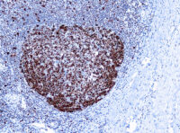 Immunohistochemical staining of Proliferating Cell Nuclear Antigen  of human FFPE tissue followed by incubation with HRP labeled secondary and development with DAB substrate.