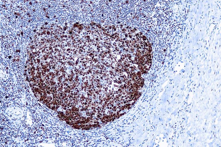 Immunohistochemical staining of Proliferating Cell Nuclear Antigen  of human FFPE tissue followed by incubation with HRP labeled secondary and development with DAB substrate.