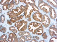 Immunohistochemical staining of Prostate Specific Antigen  of human FFPE tissue followed by incubation with HRP labeled secondary and development with DAB substrate.