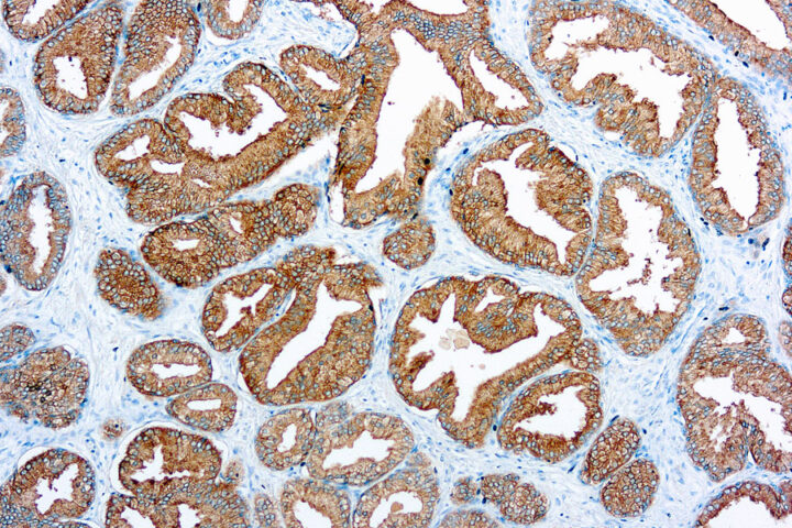 Immunohistochemical staining of Prostate Specific Antigen  of human FFPE tissue followed by incubation with HRP labeled secondary and development with DAB substrate.