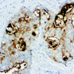 Immunohistochemical staining of Prostate Specific Membrane Antigen  of human FFPE tissue followed by incubation with HRP labeled secondary and development with DAB substrate.