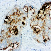 Immunohistochemical staining of Prostate Specific Membrane Antigen  of human FFPE tissue followed by incubation with HRP labeled secondary and development with DAB substrate.