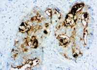 Immunohistochemical staining of Prostate Specific Membrane Antigen  of human FFPE tissue followed by incubation with HRP labeled secondary and development with DAB substrate.