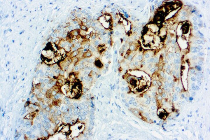 Immunohistochemical staining of Prostate Specific Membrane Antigen  of human FFPE tissue followed by incubation with HRP labeled secondary and development with DAB substrate.