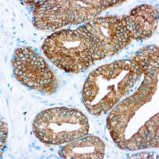 Immunohistochemical staining of Prostate Specific Antigen  of human FFPE tissue followed by incubation with HRP labeled secondary and development with DAB substrate.