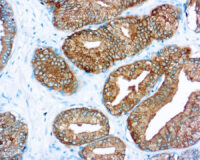 Immunohistochemical staining of Prostate Specific Antigen  of human FFPE tissue followed by incubation with HRP labeled secondary and development with DAB substrate.