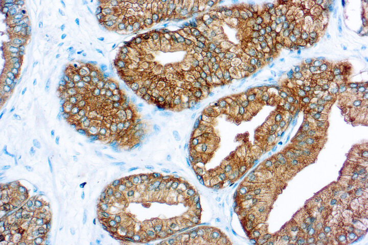 Immunohistochemical staining of Prostate Specific Antigen  of human FFPE tissue followed by incubation with HRP labeled secondary and development with DAB substrate.