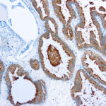 Immunohistochemical staining of Prostate Specific Antigen  of human FFPE tissue followed by incubation with HRP labeled secondary and development with DAB substrate.