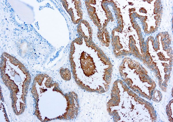 Immunohistochemical staining of Prostate Specific Antigen  of human FFPE tissue followed by incubation with HRP labeled secondary and development with DAB substrate.