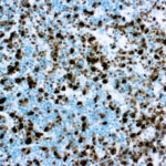 Immunohistochemical staining of Anaplastic Lymphoma Kinase  of human FFPE tissue followed by incubation with HRP labeled secondary and development with DAB substrate.