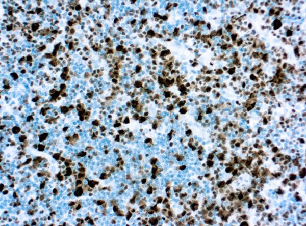 Immunohistochemical staining of Anaplastic Lymphoma Kinase  of human FFPE tissue followed by incubation with HRP labeled secondary and development with DAB substrate.