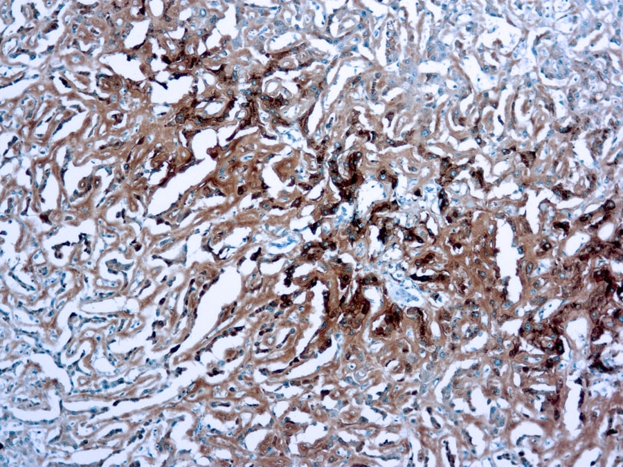 Immunohistochemical staining of Amyloid A Component  of human FFPE tissue followed by incubation with HRP labeled secondary and development with DAB substrate.