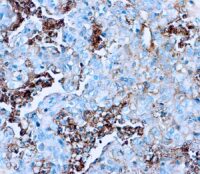 Immunohistochemical staining of Albumin  of human FFPE tissue followed by incubation with HRP labeled secondary and development with DAB substrate.