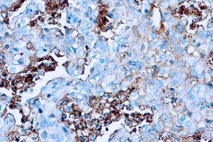 Immunohistochemical staining of Albumin  of human FFPE tissue followed by incubation with HRP labeled secondary and development with DAB substrate.