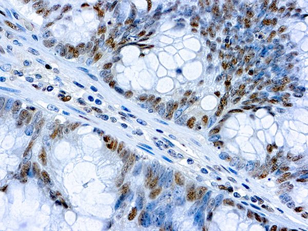Immunohistochemical staining of c-myc  of human FFPE tissue followed by incubation with HRP labeled secondary and development with DAB substrate.