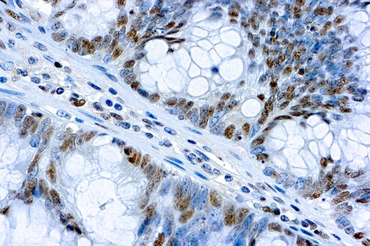 Immunohistochemical staining of c-myc  of human FFPE tissue followed by incubation with HRP labeled secondary and development with DAB substrate.