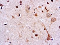 Immunohistochemical staining of CA 15-3  of human FFPE tissue followed by incubation with HRP labeled secondary and development with DAB substrate.