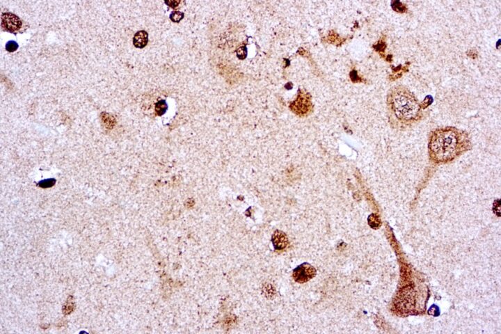 Immunohistochemical staining of CA 15-3  of human FFPE tissue followed by incubation with HRP labeled secondary and development with DAB substrate.