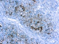 Immunohistochemical staining of CA 125  of human FFPE tissue followed by incubation with HRP labeled secondary and development with DAB substrate.