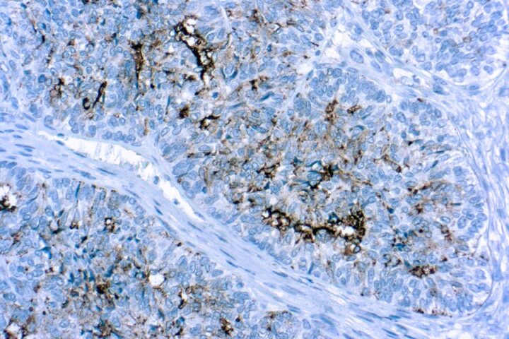Immunohistochemical staining of CA 125  of human FFPE tissue followed by incubation with HRP labeled secondary and development with DAB substrate.