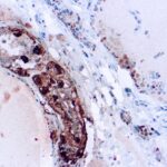 Immunohistochemical staining of Calcitonin  of human FFPE tissue followed by incubation with HRP labeled secondary and development with DAB substrate.