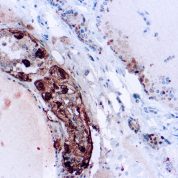 Immunohistochemical staining of Calcitonin  of human FFPE tissue followed by incubation with HRP labeled secondary and development with DAB substrate.