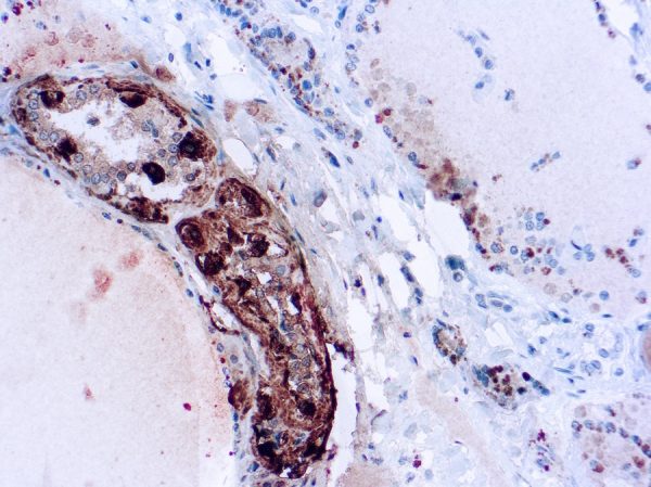 Immunohistochemical staining of Calcitonin  of human FFPE tissue followed by incubation with HRP labeled secondary and development with DAB substrate.