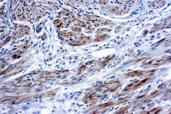 Immunohistochemical staining of Caldesmon  of human FFPE tissue followed by incubation with HRP labeled secondary and development with DAB substrate.