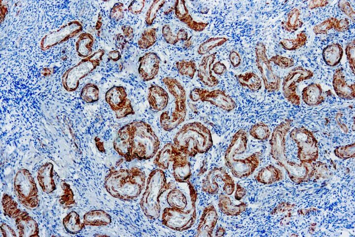 Immunohistochemical staining of Calponin  of human FFPE tissue followed by incubation with HRP labeled secondary and development with DAB substrate.