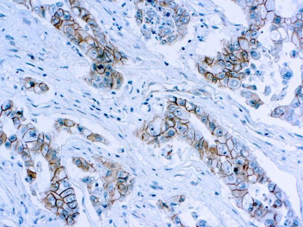 Immunohistochemical staining of Catenin, beta  of human FFPE tissue followed by incubation with HRP labeled secondary and development with DAB substrate.
