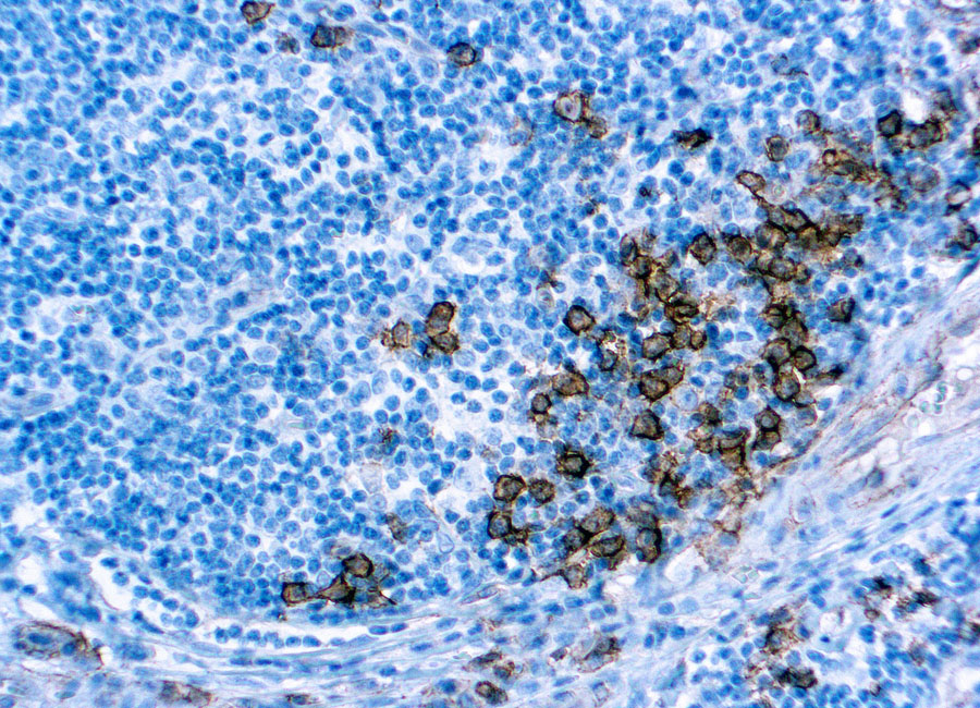 Immunohistochemical staining of CD138  of human FFPE tissue followed by incubation with HRP labeled secondary and development with DAB substrate.