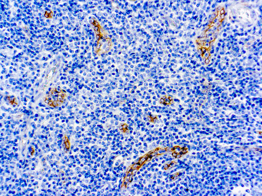 Immunohistochemical staining of CD105  of human FFPE tissue followed by incubation with HRP labeled secondary and development with DAB substrate.