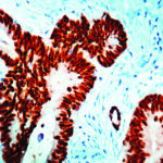 Immunohistochemical staining of CDX2  of human FFPE tissue followed by incubation with HRP labeled secondary and development with DAB substrate.