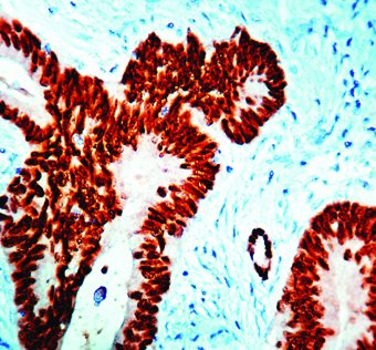 Immunohistochemical staining of CDX2  of human FFPE tissue followed by incubation with HRP labeled secondary and development with DAB substrate.