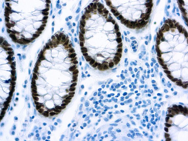 Immunohistochemical staining of Cdx2  of human FFPE tissue followed by incubation with HRP labeled secondary and development with DAB substrate.